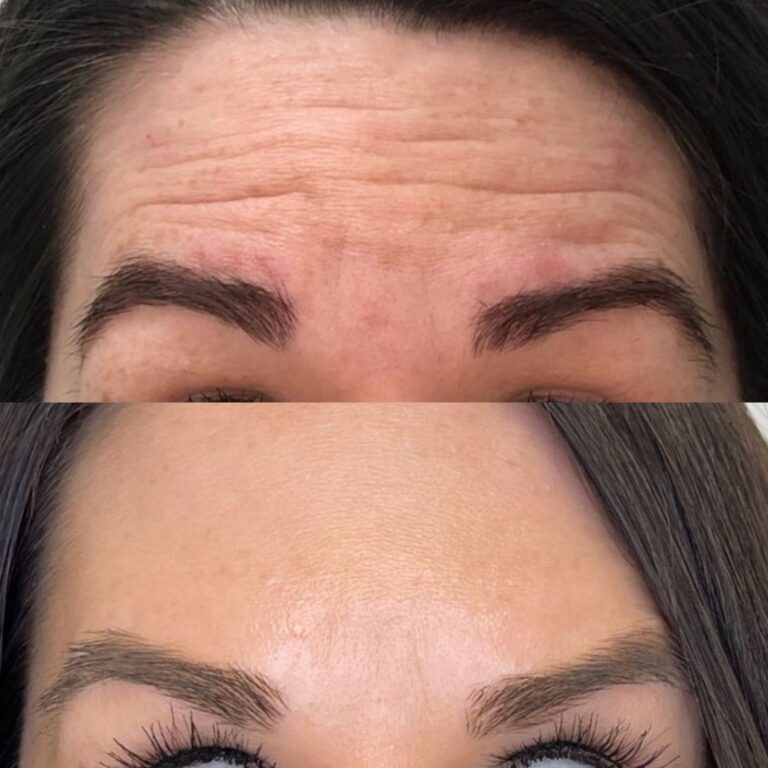 Botox Lines 768x768