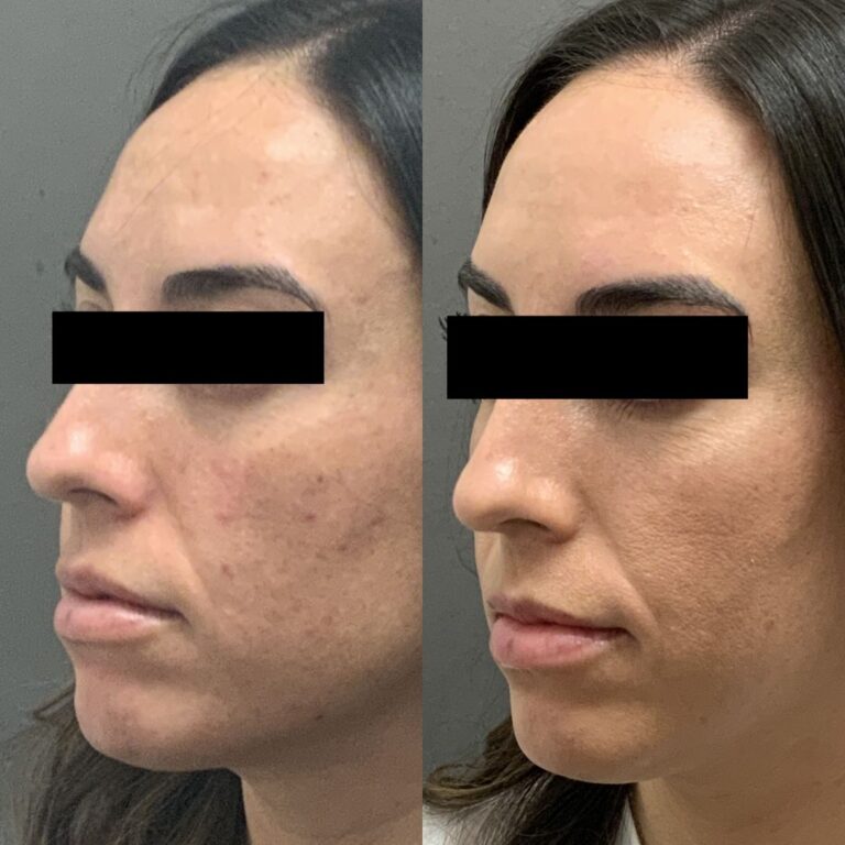 Chemical Peel 1 768x768 before and after Chemical Peel Draper UT
