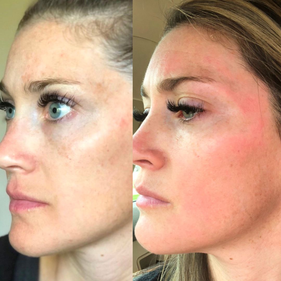 Chemical Peel before and after Chemical Peel Salt Lake City UT