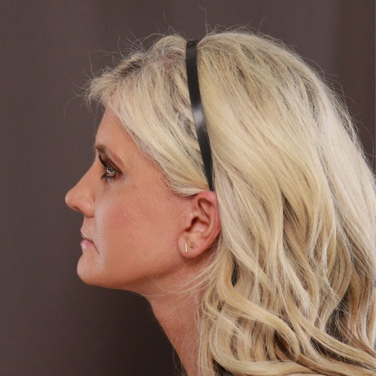 After Image: Facelift, Browlift, and Fat Grafting by Dr. Manning - left-side