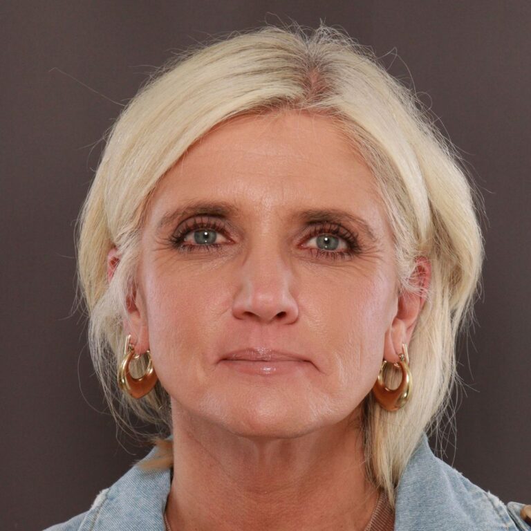 Before Image: Facelift, Browlift, and Fat Grafting by Dr. Manning - front