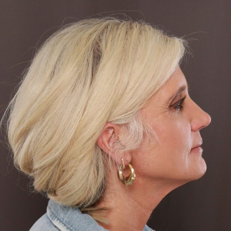 Before Image: Facelift, Browlift, and Fat Grafting by Dr. Manning - front