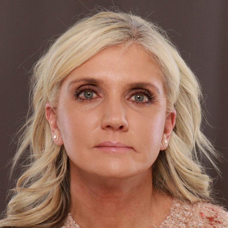 After Image: Facelift, Browlift, and Fat Grafting by Dr. Manning - front