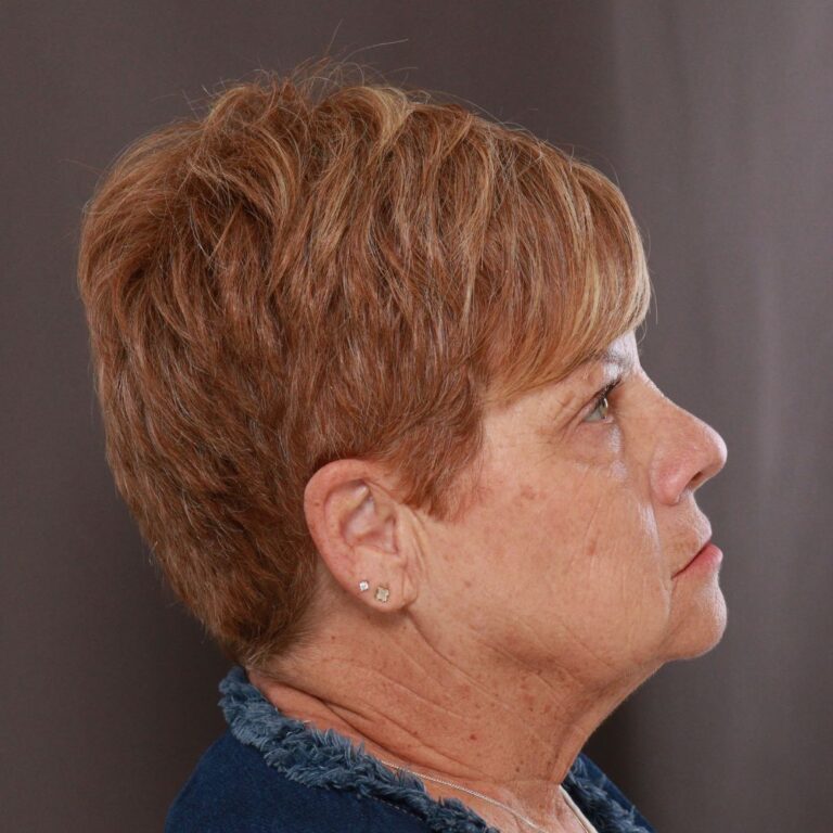 Before Image: Contour TRL by Katy Larson - right-side