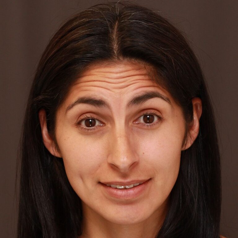 Before Image: Botox - front
