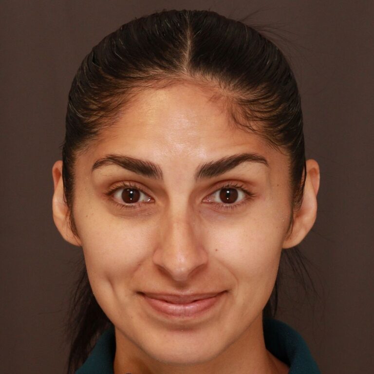 After Image: Botox - front