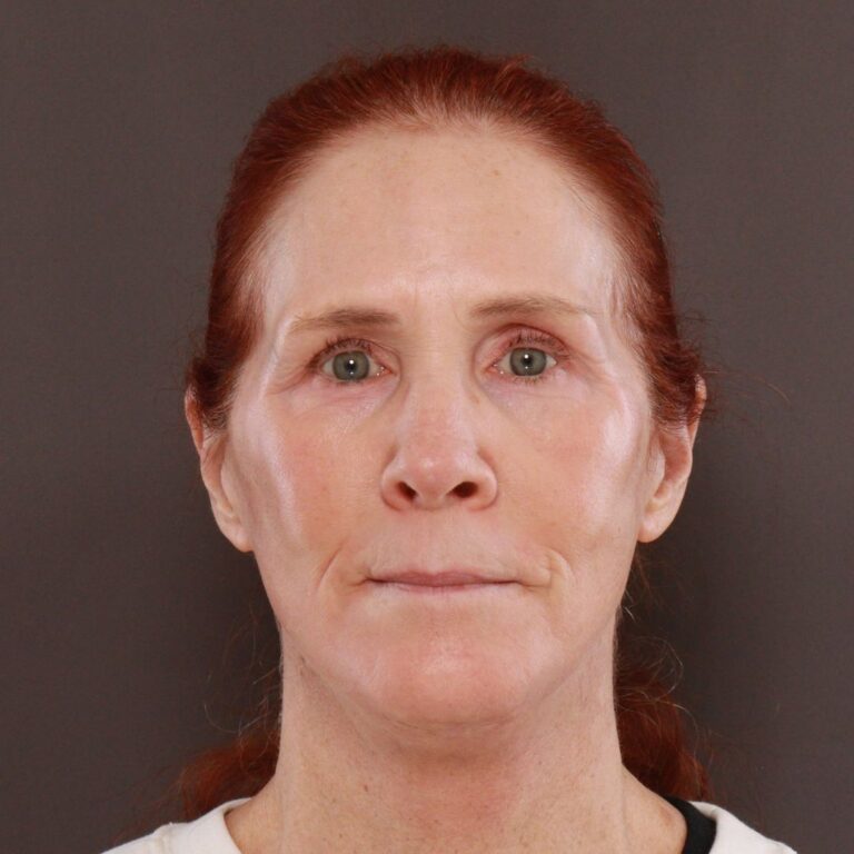 After Image: Facelift, Upper Blepharoplasty by Dr. Thompson & Contour TRL by Katy Larson - front