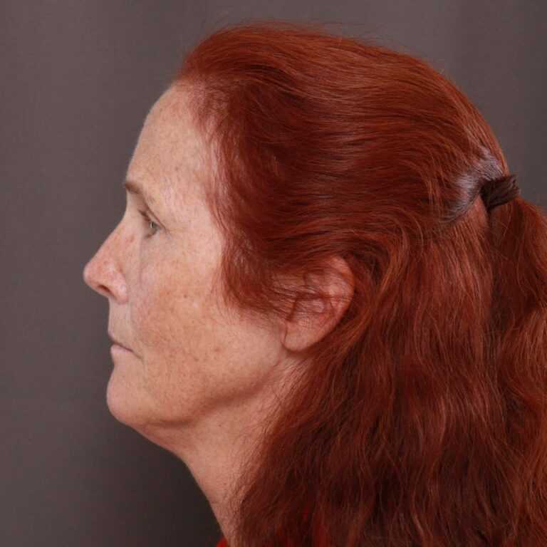 Before Image: Facelift, Upper Blepharoplasty by Dr. Thompson & Contour TRL by Katy Larson - left-side