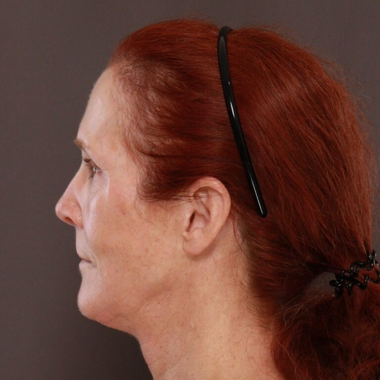 After Image: Facelift, Upper Blepharoplasty by Dr. Thompson & Contour TRL by Katy Larson - left-side