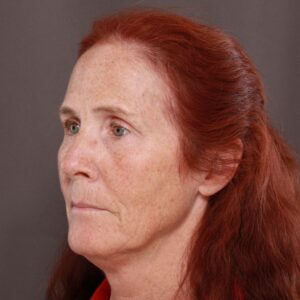 Before Image: Facelift, Upper Blepharoplasty by Dr. Thompson & Contour TRL by Katy Larson