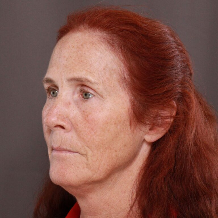 Before Image: Facelift, Upper Blepharoplasty by Dr. Thompson & Contour TRL by Katy Larson - left-front-oblique