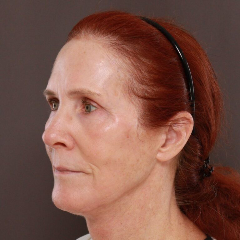 After Image: Facelift, Upper Blepharoplasty by Dr. Thompson & Contour TRL by Katy Larson - left-front-oblique