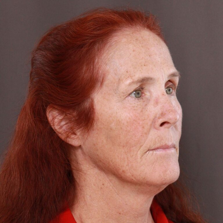 Before Image: Facelift, Upper Blepharoplasty by Dr. Thompson & Contour TRL by Katy Larson - right-front-oblique