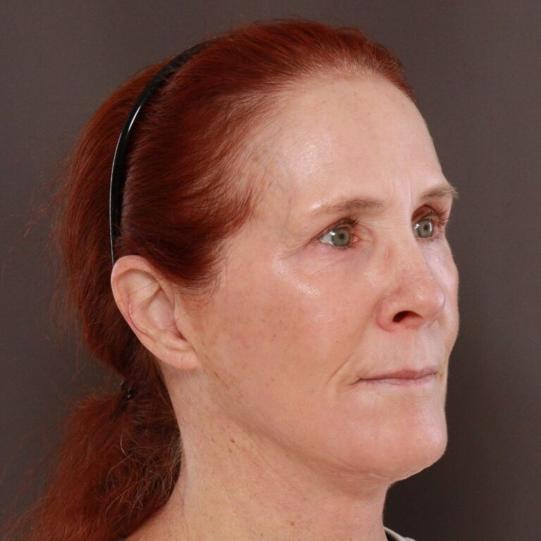 After Image: Facelift, Upper Blepharoplasty by Dr. Thompson & Contour TRL by Katy Larson - right-front-oblique