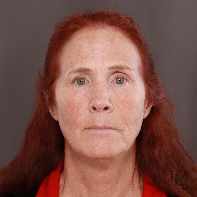 Before Image: Facelift, Upper Blepharoplasty by Dr. Thompson & Contour TRL by Katy Larson - front