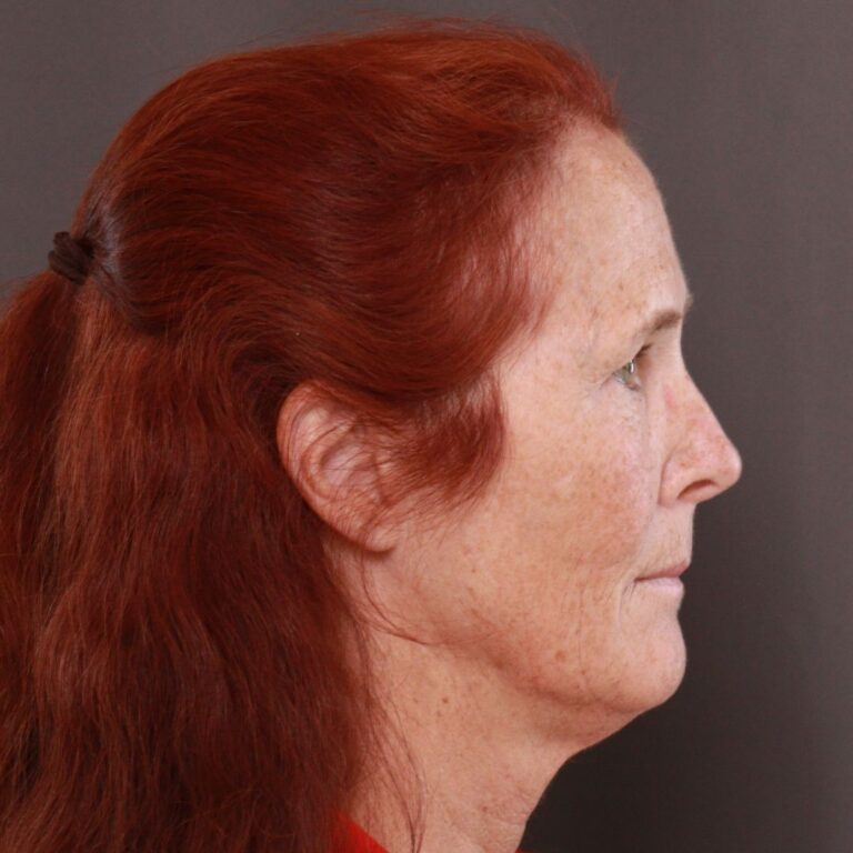 Before Image: Facelift, Upper Blepharoplasty by Dr. Thompson & Contour TRL by Katy Larson - right-side