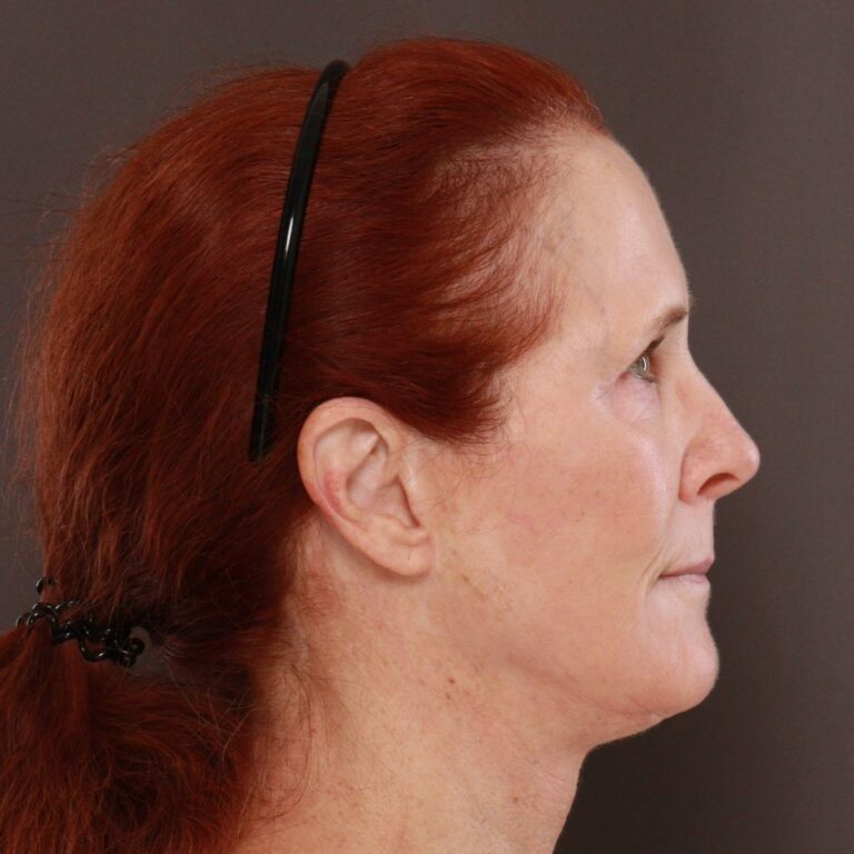 After Image: Facelift, Upper Blepharoplasty by Dr. Thompson & Contour TRL by Katy Larson - right-side