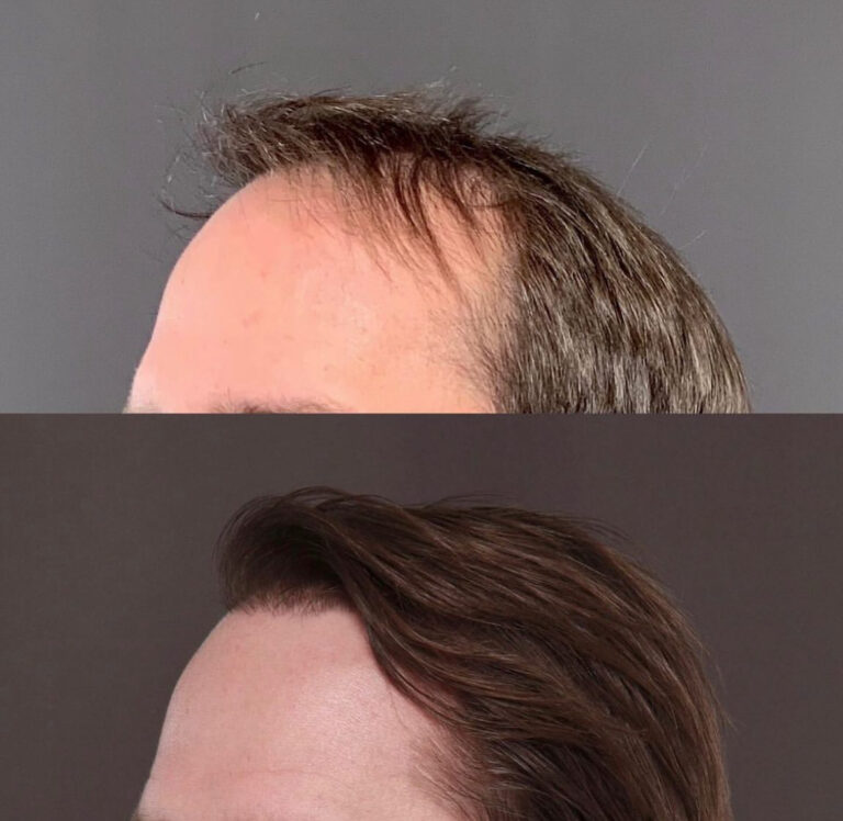 Before and after Hair Restoration Salt Lake City UT