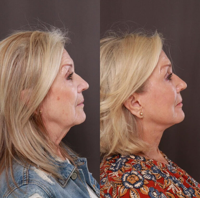 Facelift 1 768x762