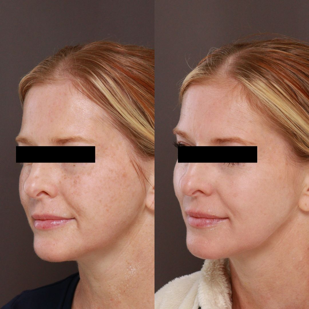 Halo before and after before and after Halo Laser Treatment Salt Lake City UT