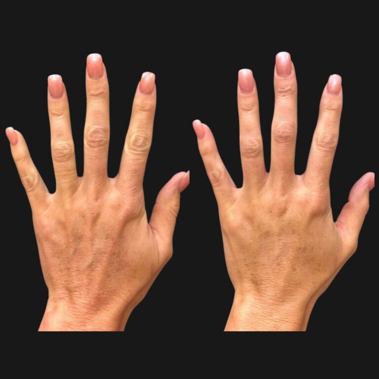 Hand Rejuvenation 768x768 Hand Rejuvenation 768x768