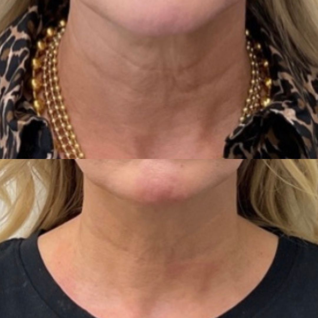 Hyperdilute Radiesse