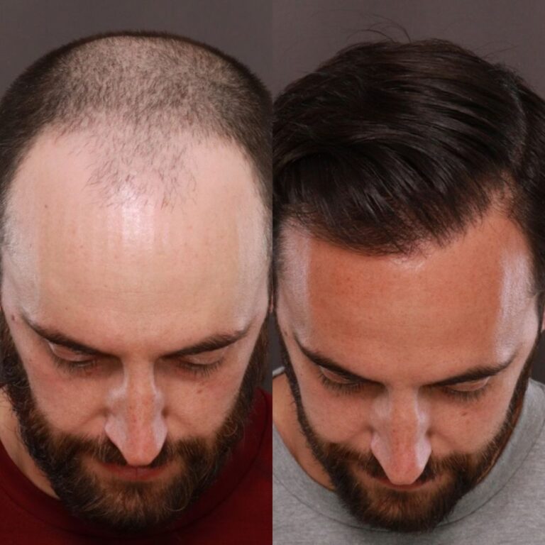 Before and after Hair Transplants Salt Lake City UT
