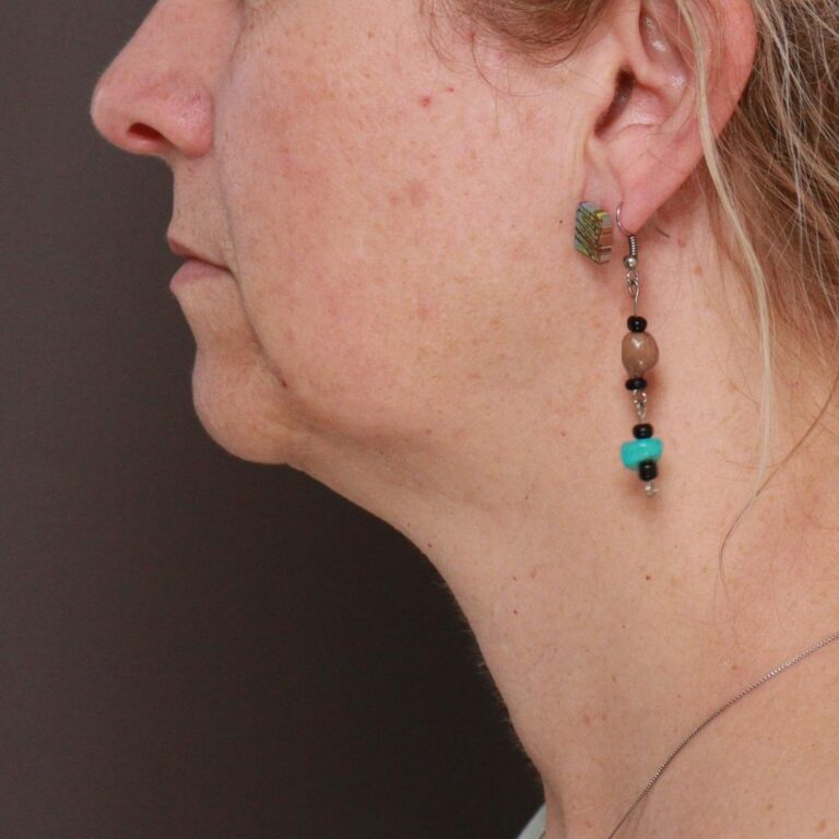 Before Image: Deep Neck Contour with Chin Pexy by Dr. Manning - left-side