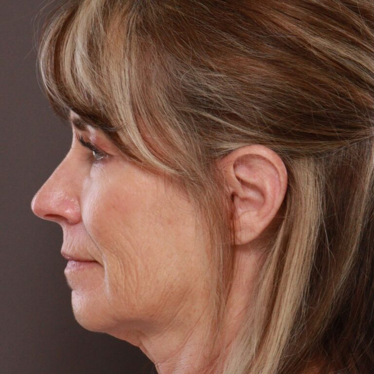 Before Image: Contour TRL by Katy Larson - left-side