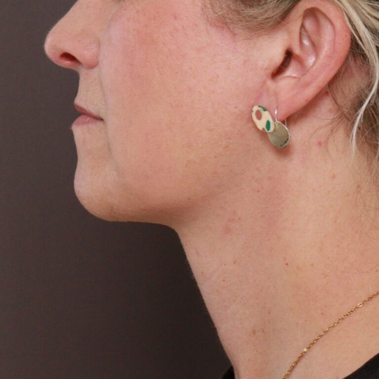 After Image: Deep Neck Contour with Chin Pexy by Dr. Manning - left-side