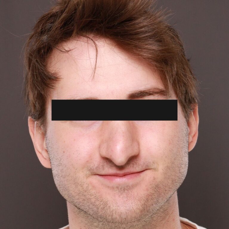 Before Image: Rhinoplasty by Dr. Thompson - front