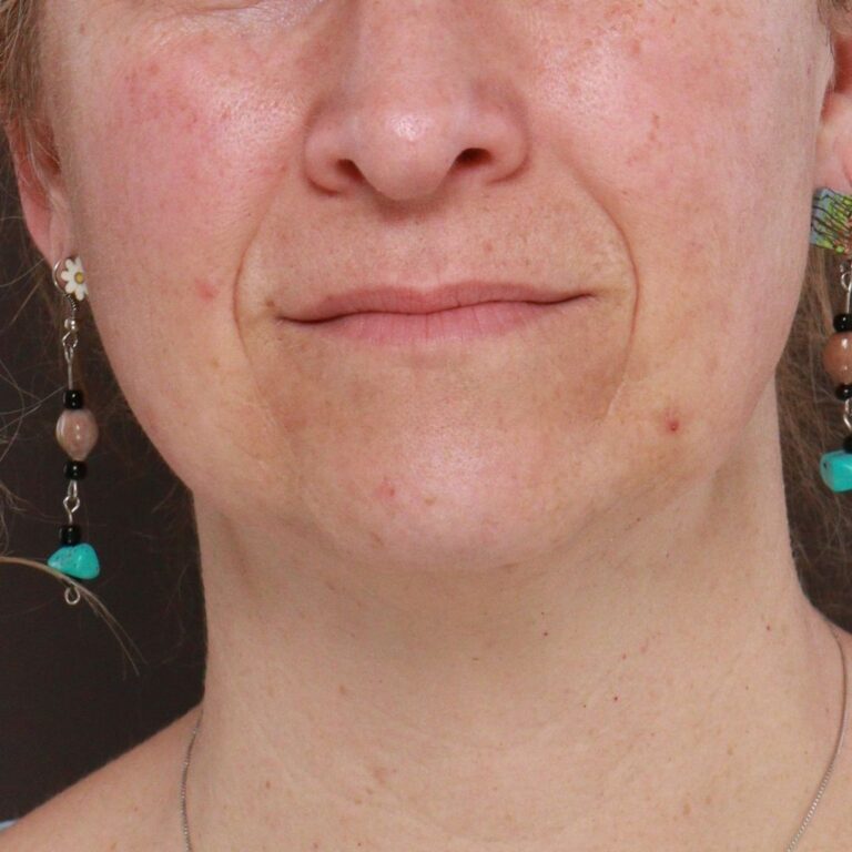 Before Image: Deep Neck Contour with Chin Pexy by Dr. Manning - front