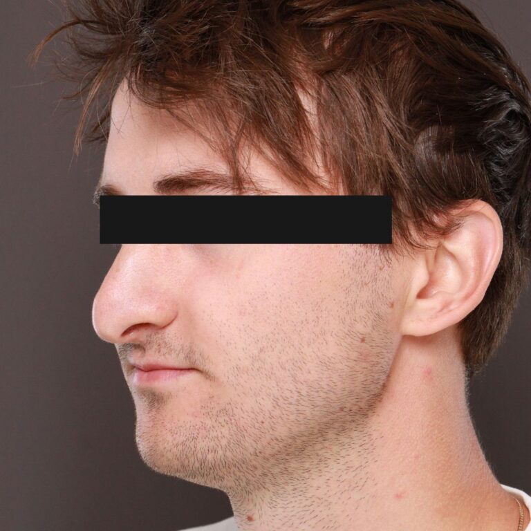 Before Image: Rhinoplasty by Dr. Thompson - left-front-oblique