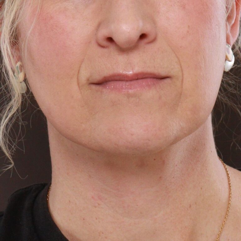 After Image: Deep Neck Contour with Chin Pexy by Dr. Manning - front
