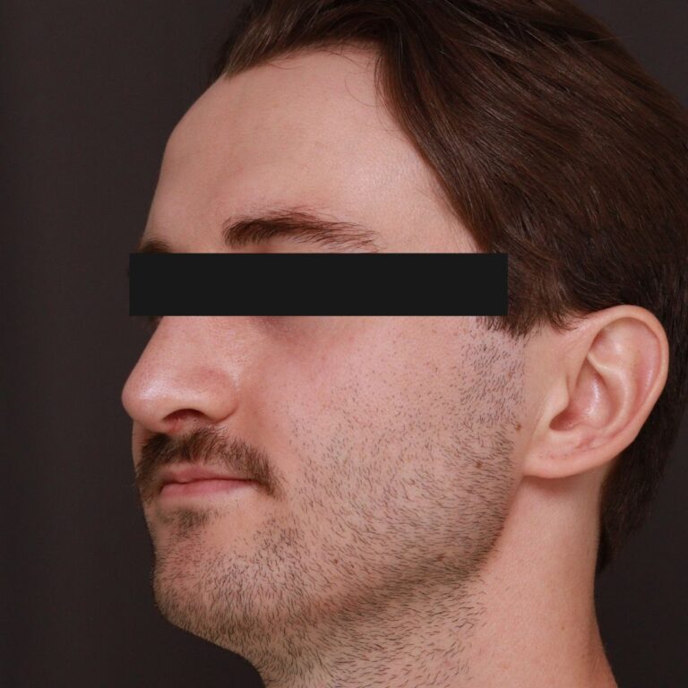 After Image: Rhinoplasty by Dr. Thompson - left-front-oblique
