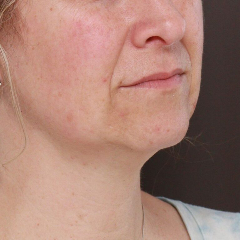 Before Image: Deep Neck Contour with Chin Pexy by Dr. Manning - left-front-oblique
