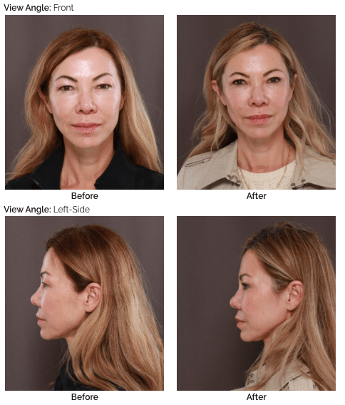 Vale la pena la blefaroplastia? Resultados y perspectivas de