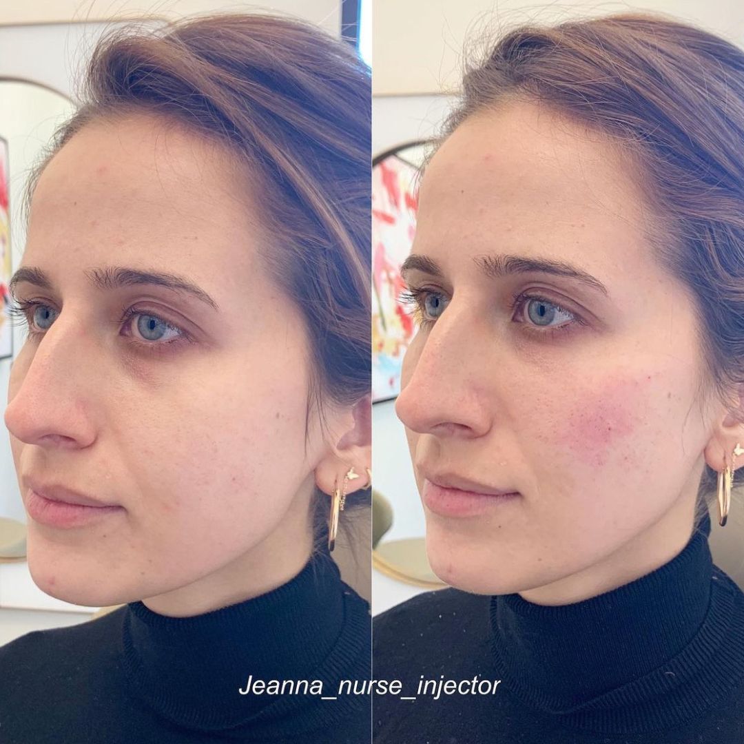 Under Eye Results