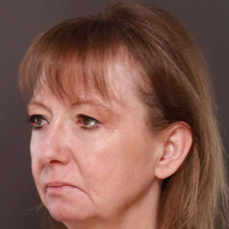 After Image: Lower Blepharoplasty by Dr. Henstrom - left-front-oblique