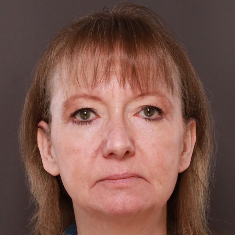 After Image: Lower Blepharoplasty by Dr. Henstrom - front