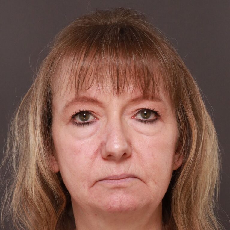 Before Image: Lower Blepharoplasty by Dr. Henstrom - front