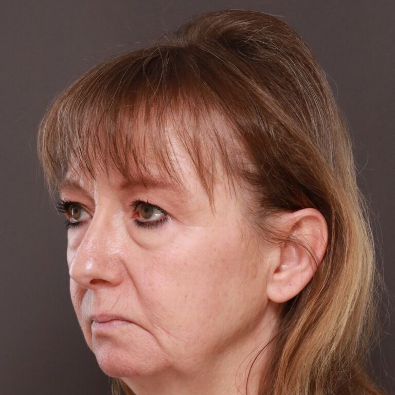 Before Image: Lower Blepharoplasty by Dr. Henstrom - left-front-oblique