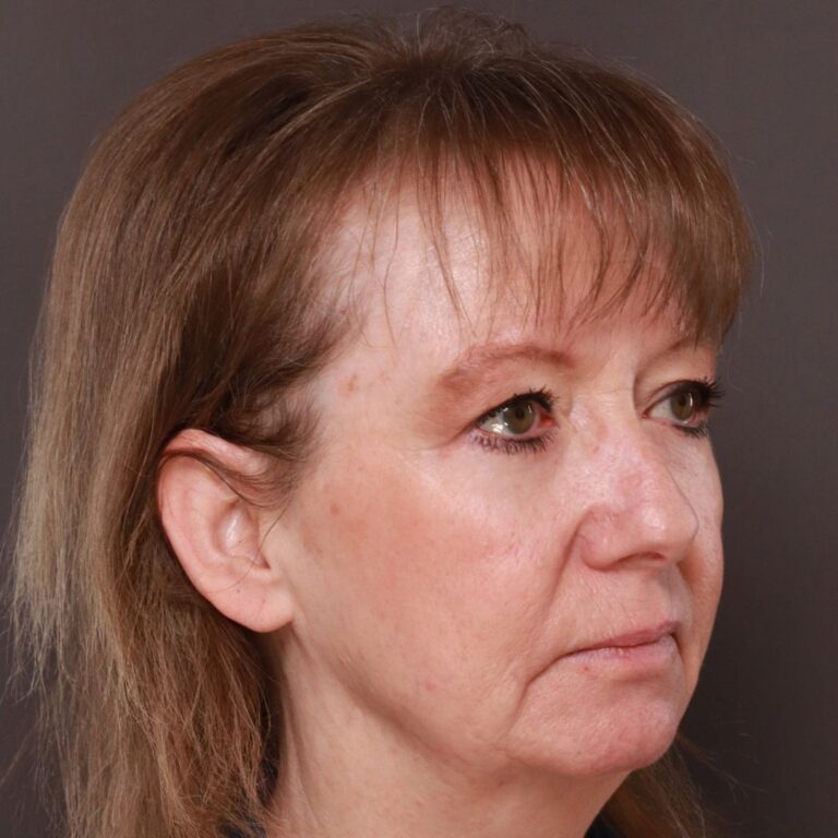 After Image: Lower Blepharoplasty by Dr. Henstrom - right-front-oblique