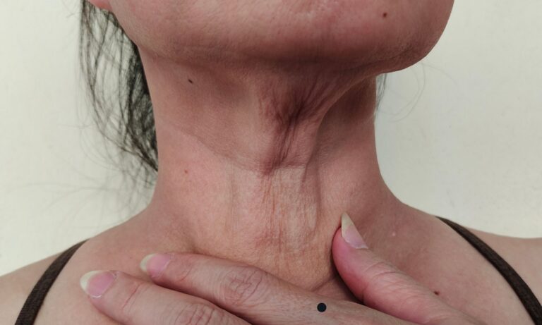 neck lift