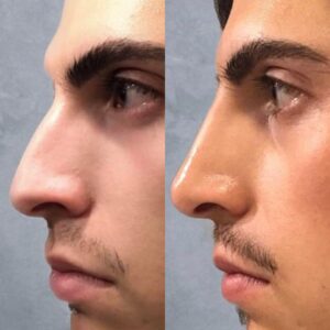 non surgical rhino 3