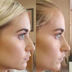 non surgical rhino 4 1024x1024