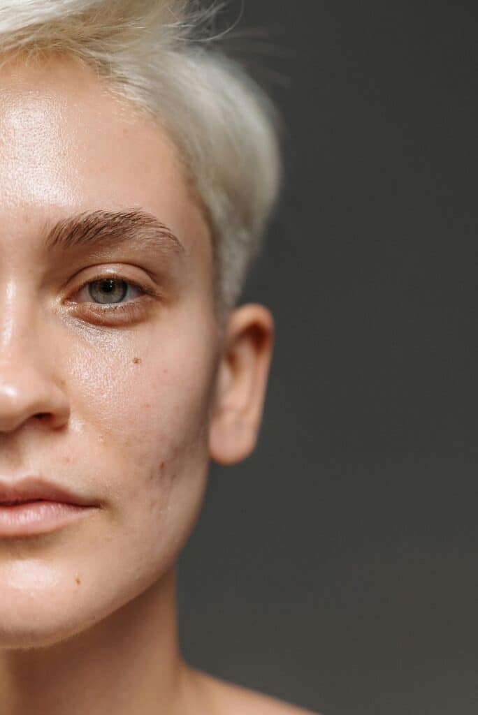 eye surgery for wrinkles in utah