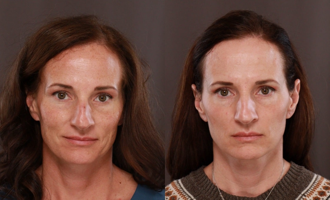 Utah Facial Plastics Halo and BBL Laser Treatments Utah Facial Plastics Halo and BBL Laser Treatments