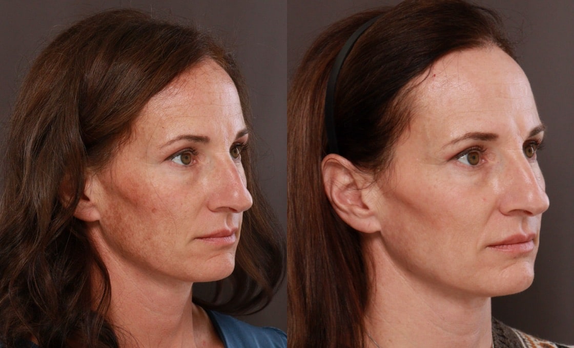 Utah Facial Plastics Halo and BBL Laser Treatments Utah Facial Plastics Halo and BBL Laser Treatments