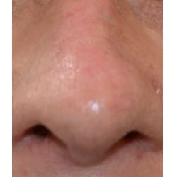 After Image: Mohs Reconstruction by Dr. Thompson - front